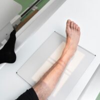 عکس برداری از پای پرانتزی قبل از جراحی